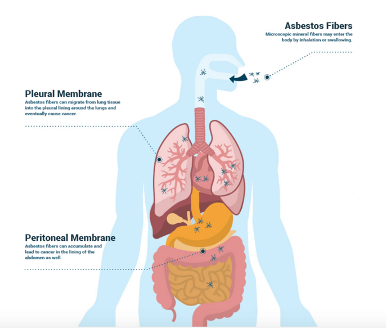 mesothelioma